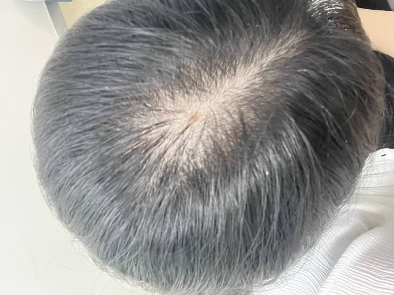 [잡담] 탈모때메죽고싶다 | 인스티즈