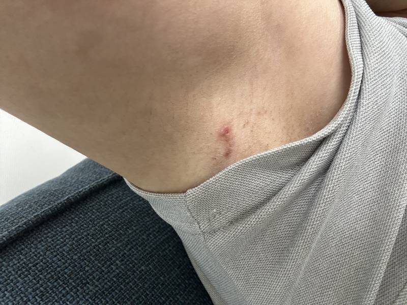 [잡담] 이렇게 아토피났는데 병원 가봐야 할까?ㅠㅠ | 인스티즈
