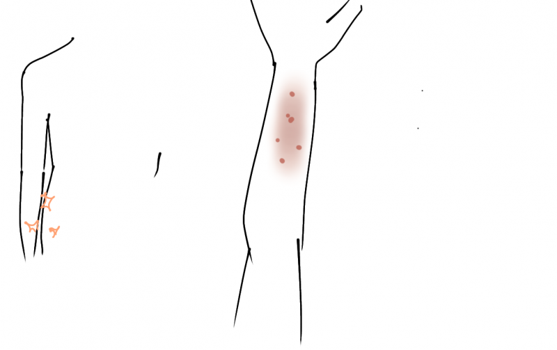 [잡담] 이거 어케 고치지 골반쪽 옷에 쓸려서 여름때마다 팔에 진물남... | 인스티즈