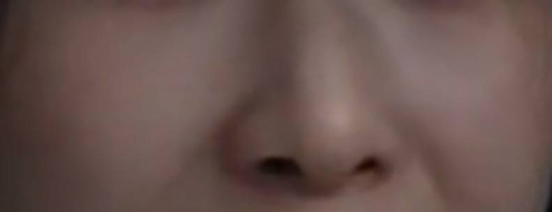[잡담] 하 콧구멍 차이 어쩌지 수술할려고 하는데 이건 너무한거 아니냐ㅠ | 인스티즈