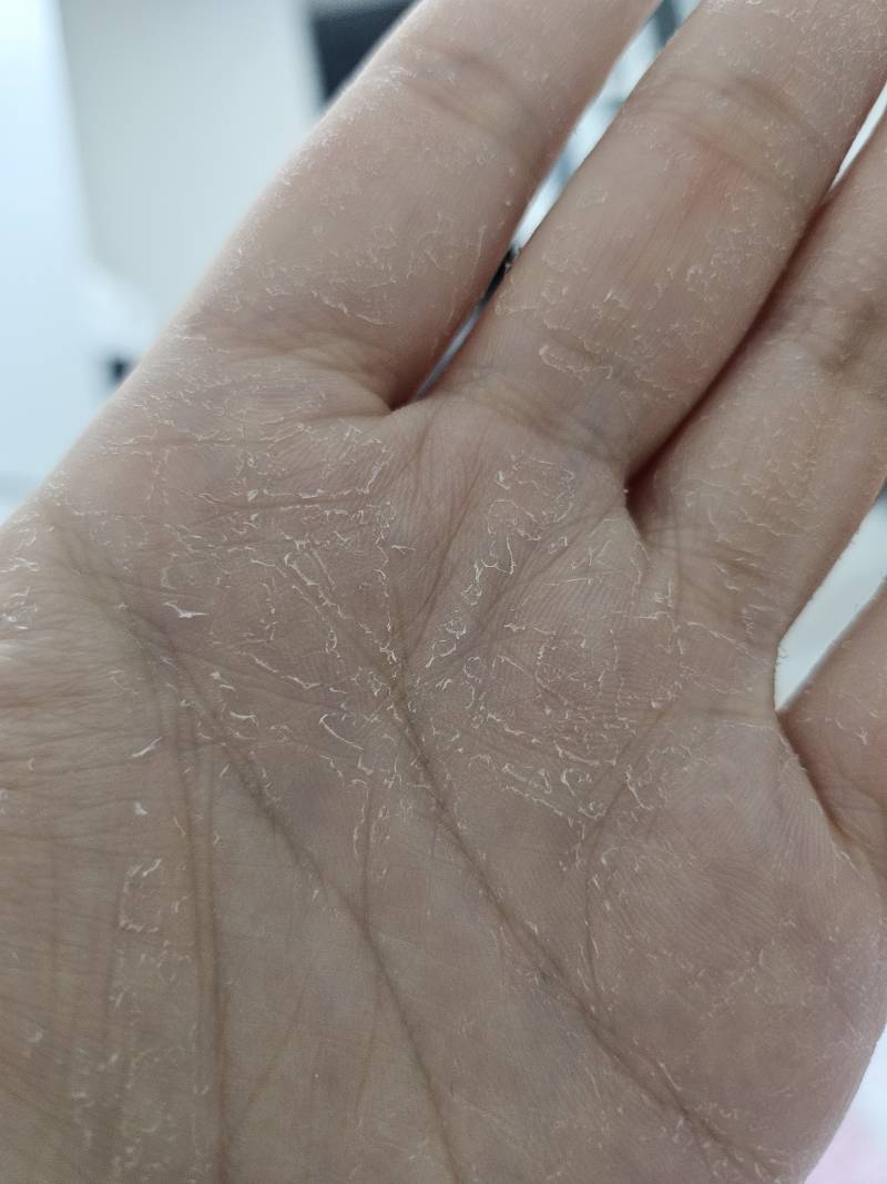 [잡담] 이거 습진임....? | 인스티즈