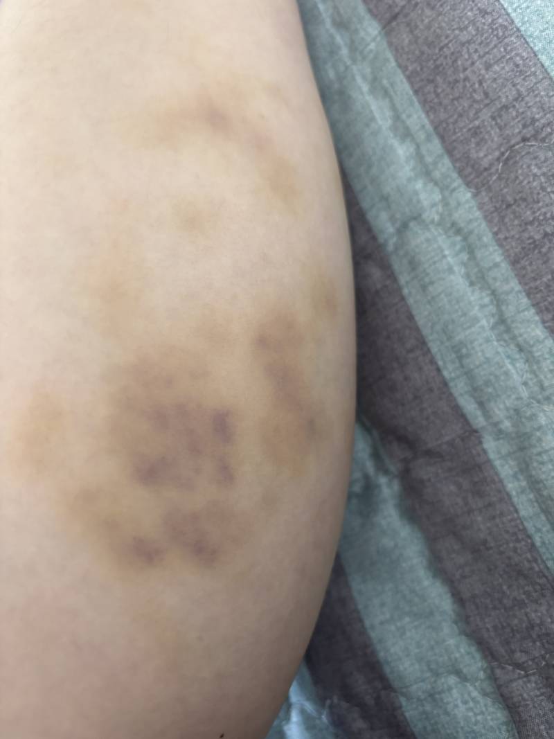 [잡담] 지압봉? 같은걸로 종아리 뒤에 마사지했는데 이렇게 멍들었엌ㅋㅋㅋ.. | 인스티즈