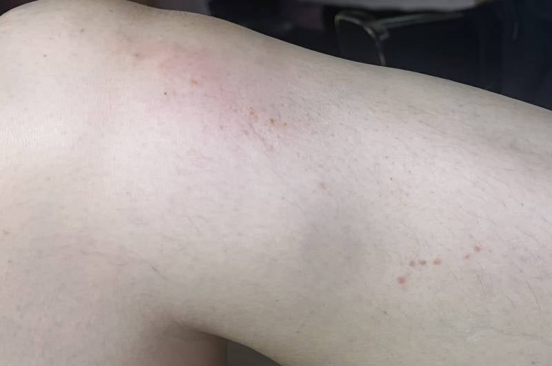 [잡담] 이거 빈대물린 자국같아??;;; | 인스티즈