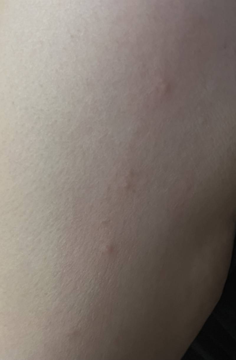 [잡담] 이거 빈대물린 자국같아??;;; | 인스티즈