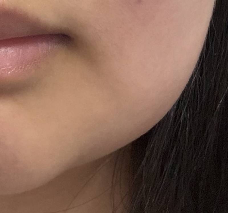 [잡담] 사랑니 뺀거 붓기 심각하다 진짜 ㅋㅋㅋ | 인스티즈