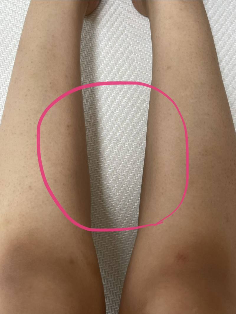 [잡담] 종아리보톡스 진짜진짜 만족이었는데 부작용 왔네.. | 인스티즈