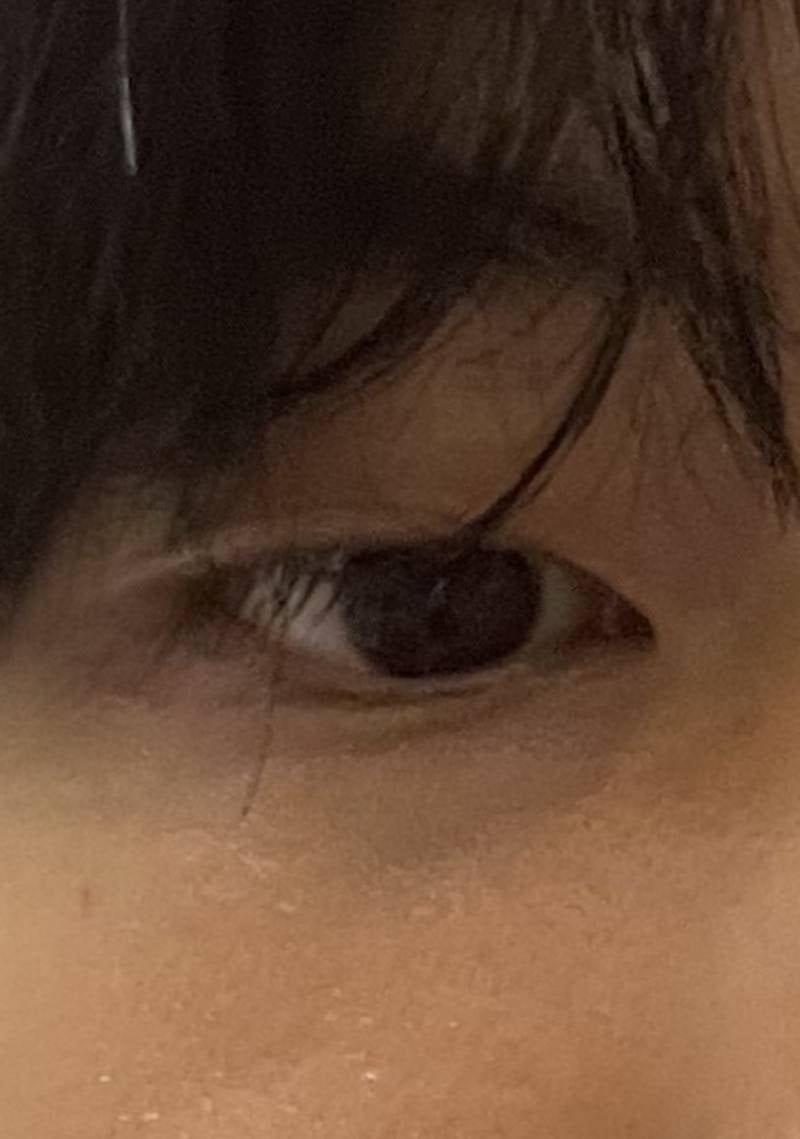 [잡담] 비염형 다크서클은 레이저토닝 효과있어? | 인스티즈