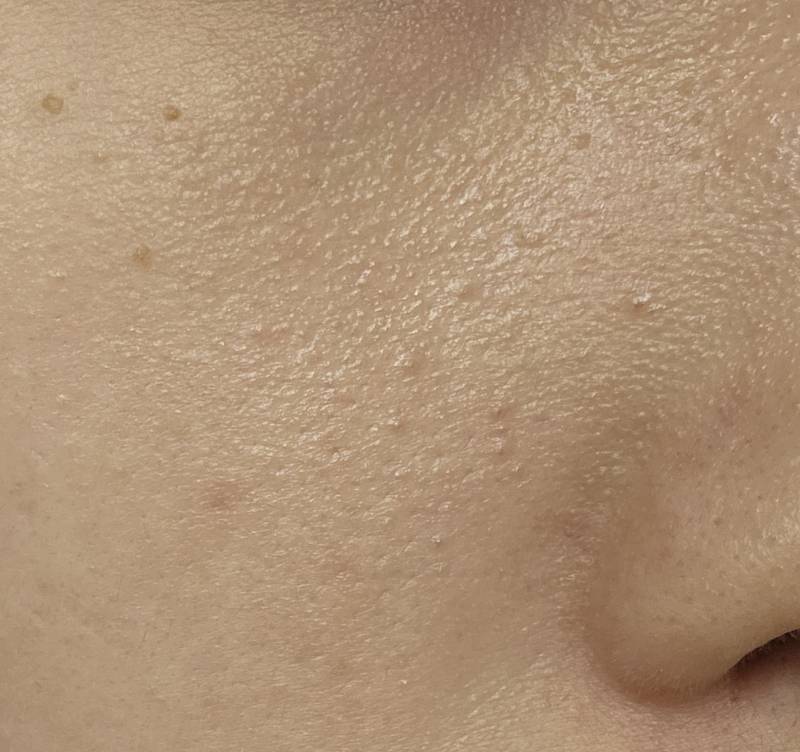 [잡담] 눈 밑 요철 편평사마귀일까 비립종일까? | 인스티즈