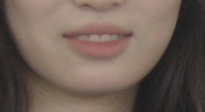 [잡담] 나 턱끝 필러 맞아야 할 것 같아? | 인스티즈