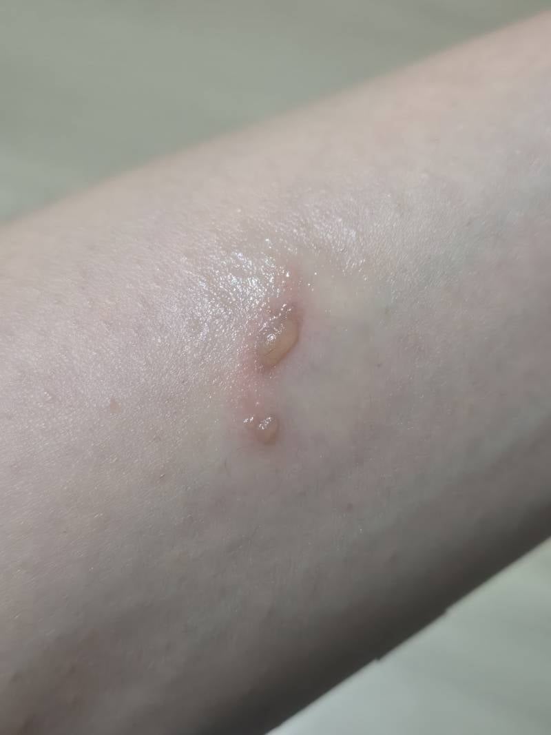 [잡담] 화상 물집 잡힌 거 터뜨리면 안 되지..? | 인스티즈