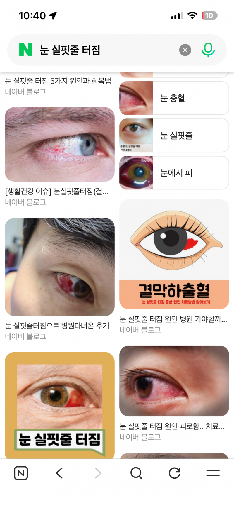 [잡담] 눈 실핏줄 터져서 이렇게 됐는데 (혐주의) | 인스티즈