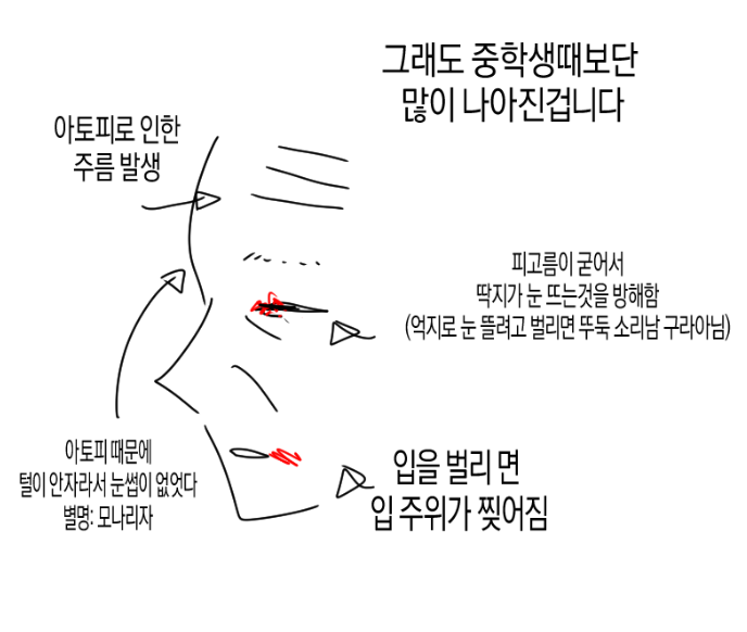 (충격) 아토피가 𝙅𝙊𝙉𝙉𝘼 힘든 이유..JPG | 인스티즈