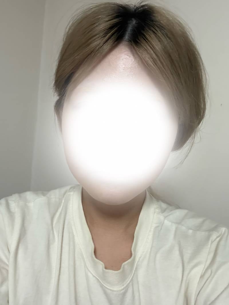 [잡담] 나 양악 윤곽했는데 붓기 많아보여? | 인스티즈