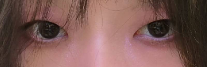 [잡담] 성형) 내 눈 앞트임 해도 될까?(사진) | 인스티즈