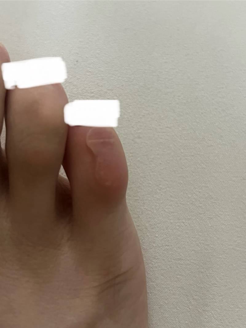 [잡담] 발가락에 이따만한 물집 잡혔는데 이렇게 아파도 돼??? | 인스티즈
