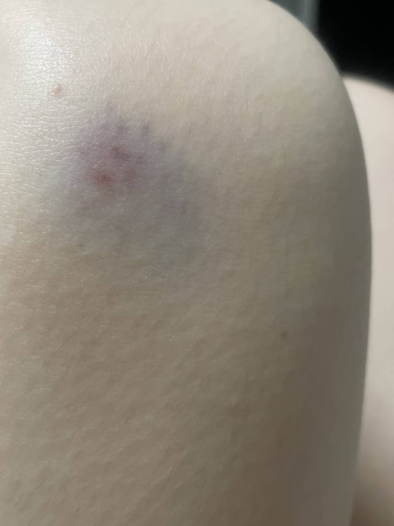 [잡담] 나 똑같은곳 두번 부딪혀서 멍들었어 얘들아ㅜㅜ | 인스티즈