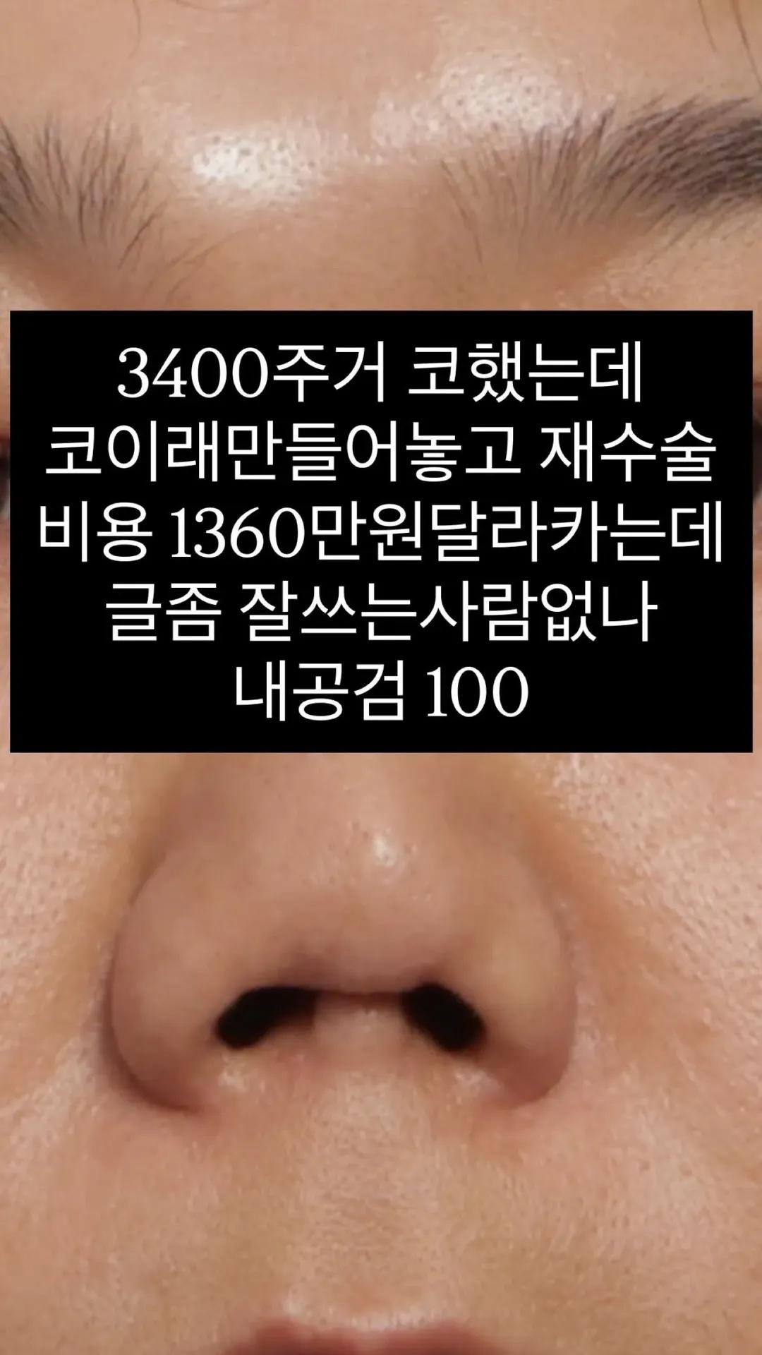 [정보/소식] 코 성형수술 부작용 피해 속출중이라는 강남성형외과 | 인스티즈