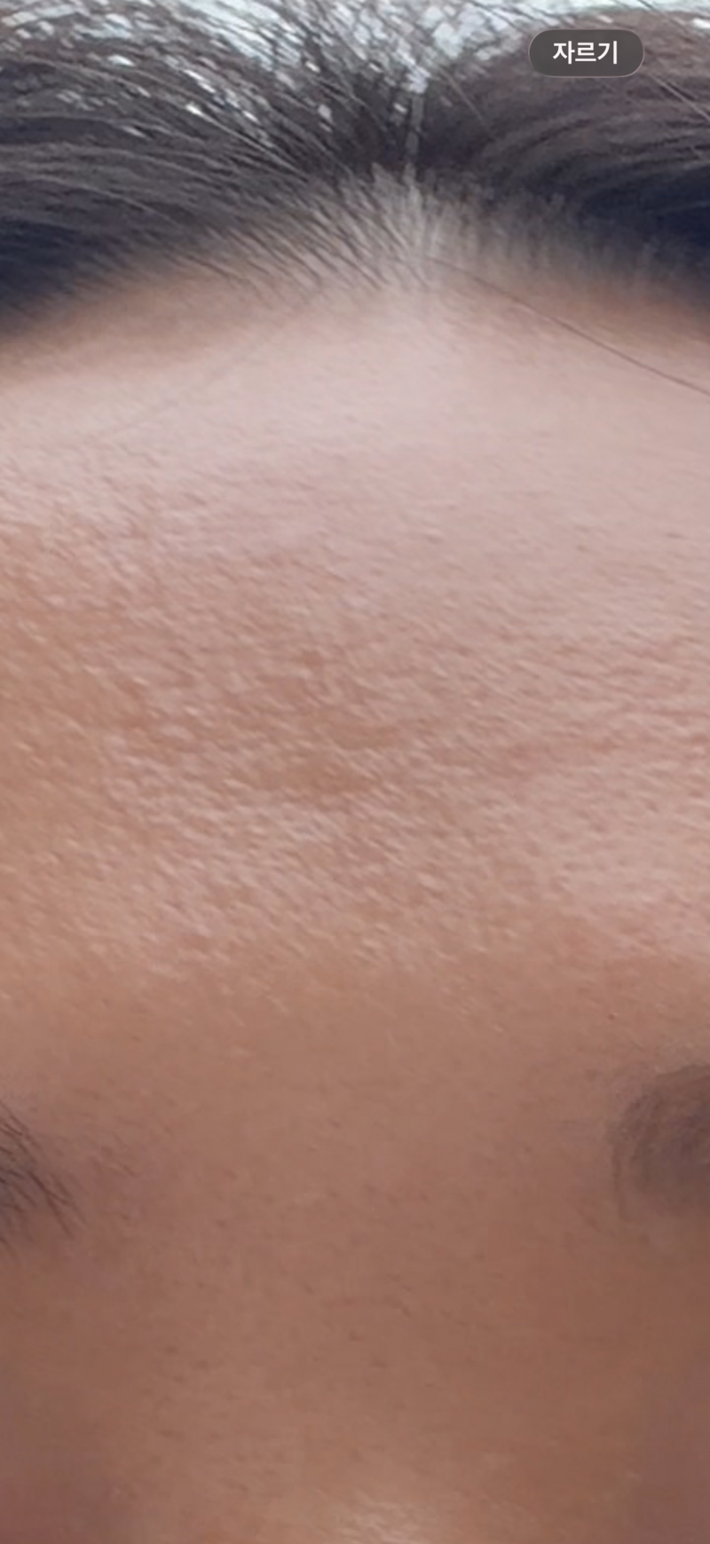 [잡담] 피부 시술 추천 부탁..ㅠㅠ | 인스티즈