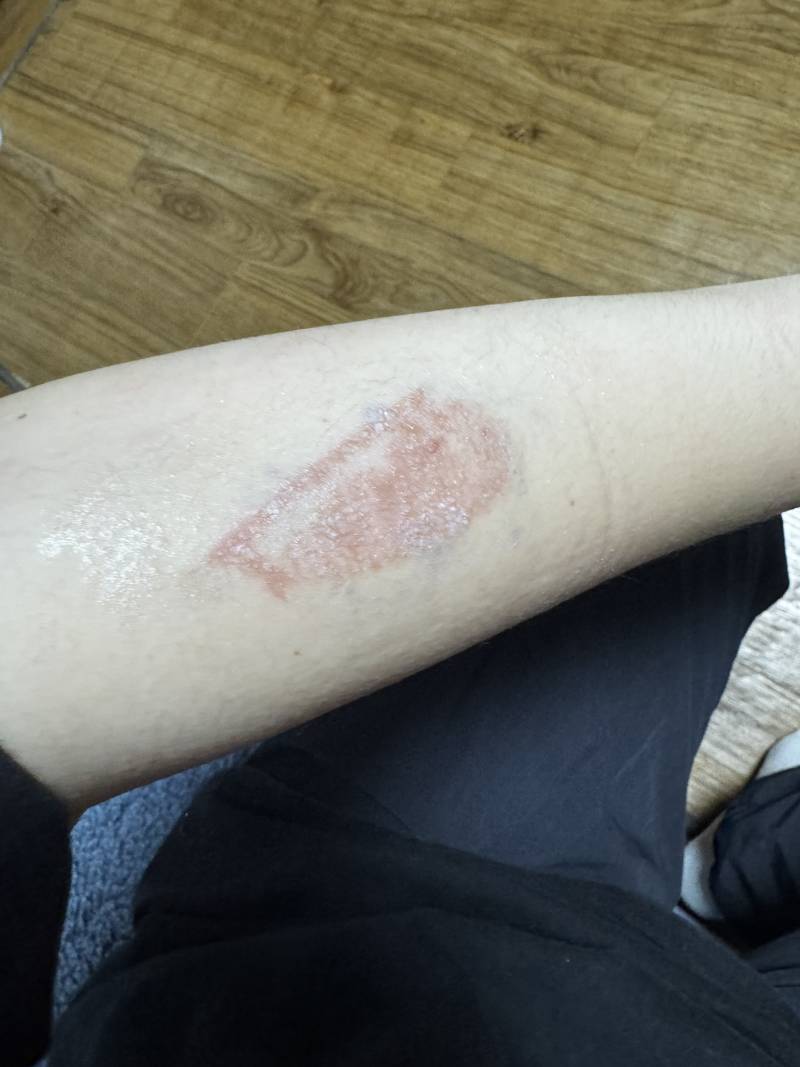 [잡담] 회사에서 화상 입었는데 (화상 입은거 사진 주의) | 인스티즈