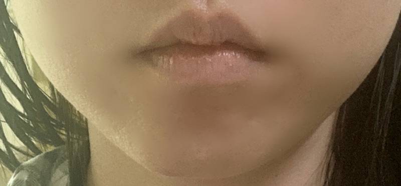 [잡담] 입술필러 할말 | 인스티즈