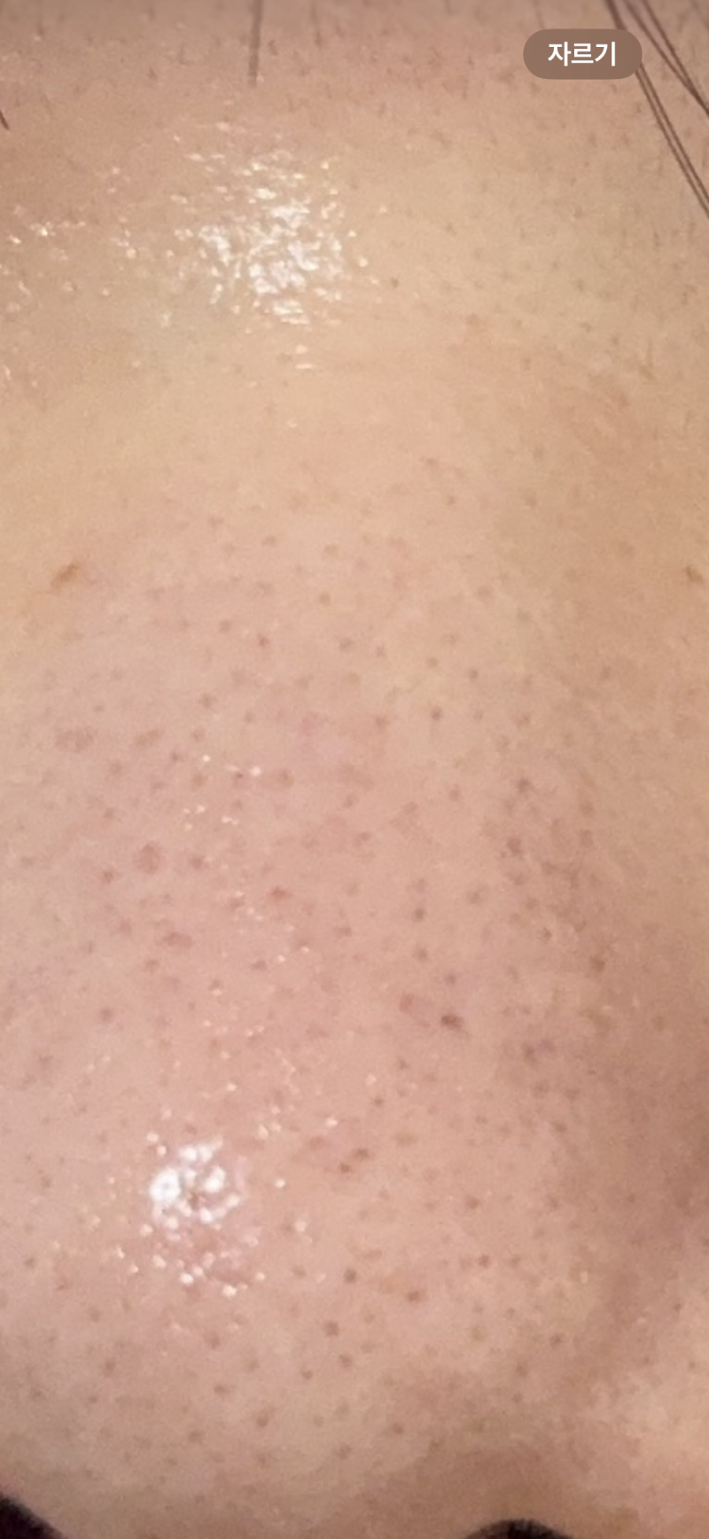 [잡담] ㅎㅇㅈㅇ 이건 레이저 맞아야되는 피부야?? | 인스티즈