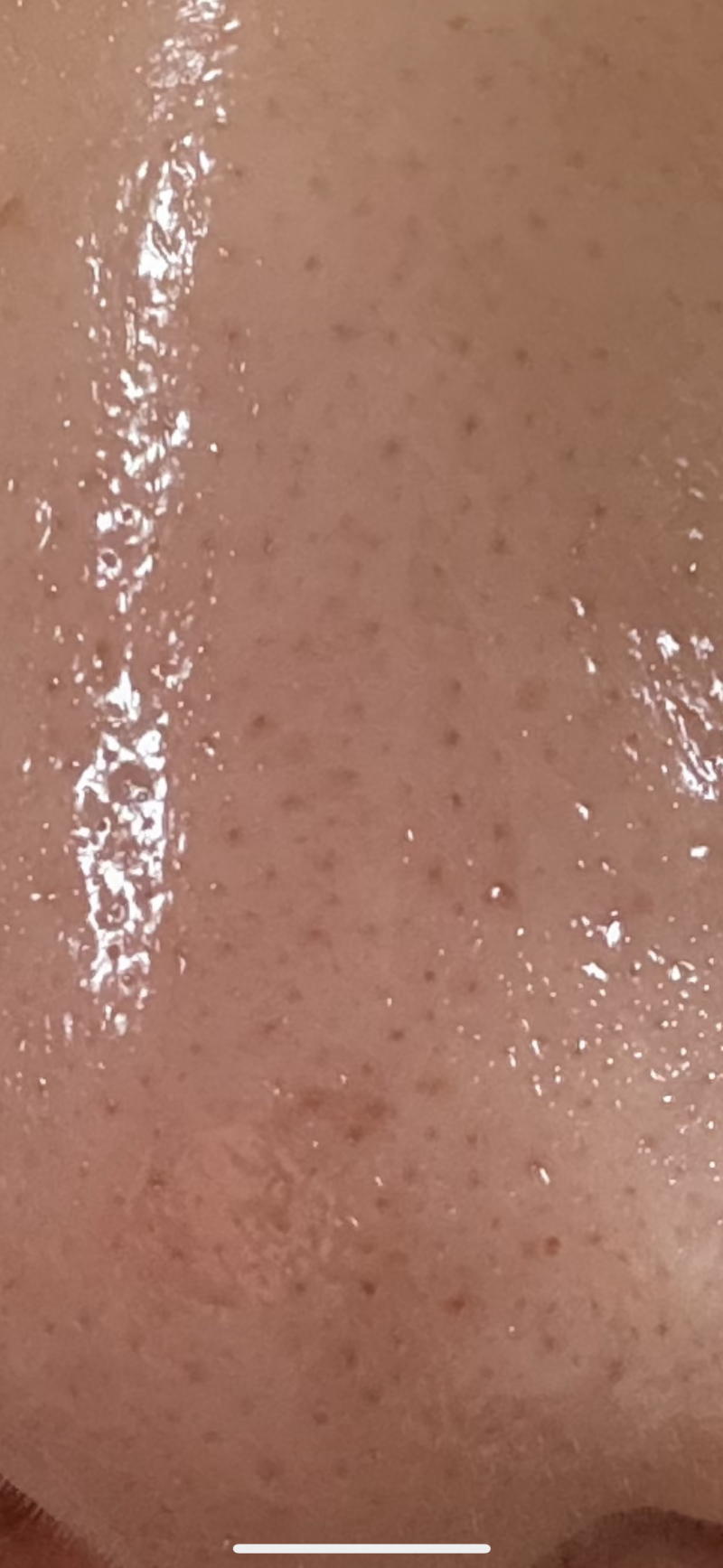 [잡담] ㅎㅇㅈㅇ 이건 레이저 맞아야되는 피부야?? | 인스티즈