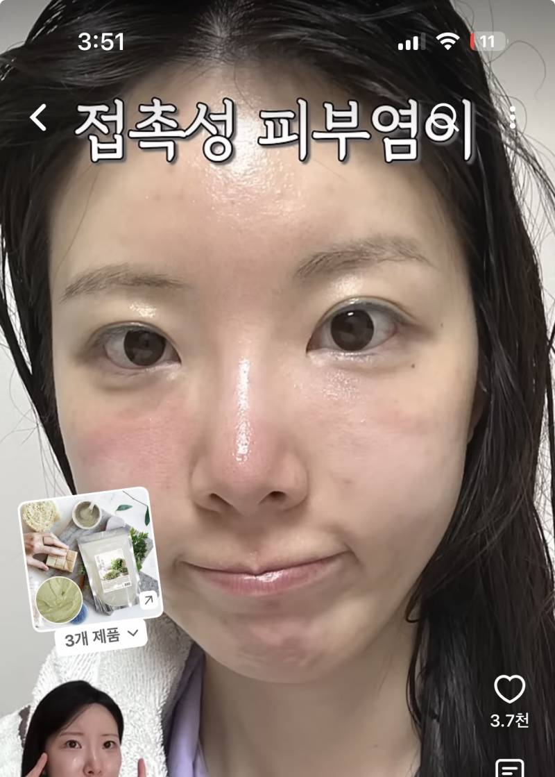 [잡담] 접촉성 피부염 사람 미치게함 ㅠ | 인스티즈
