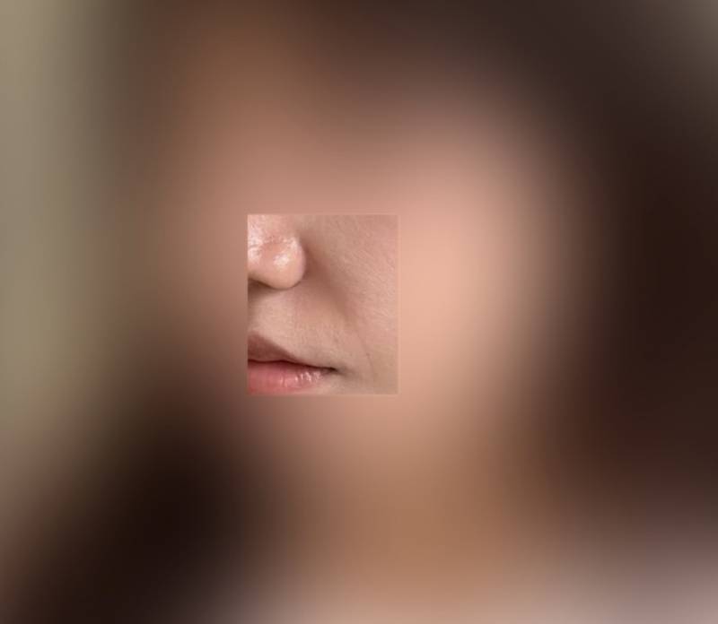 [잡담] 피부과 종사자나 팔자나 피부재생 시술? 잘알 익들 ㅠㅠ | 인스티즈