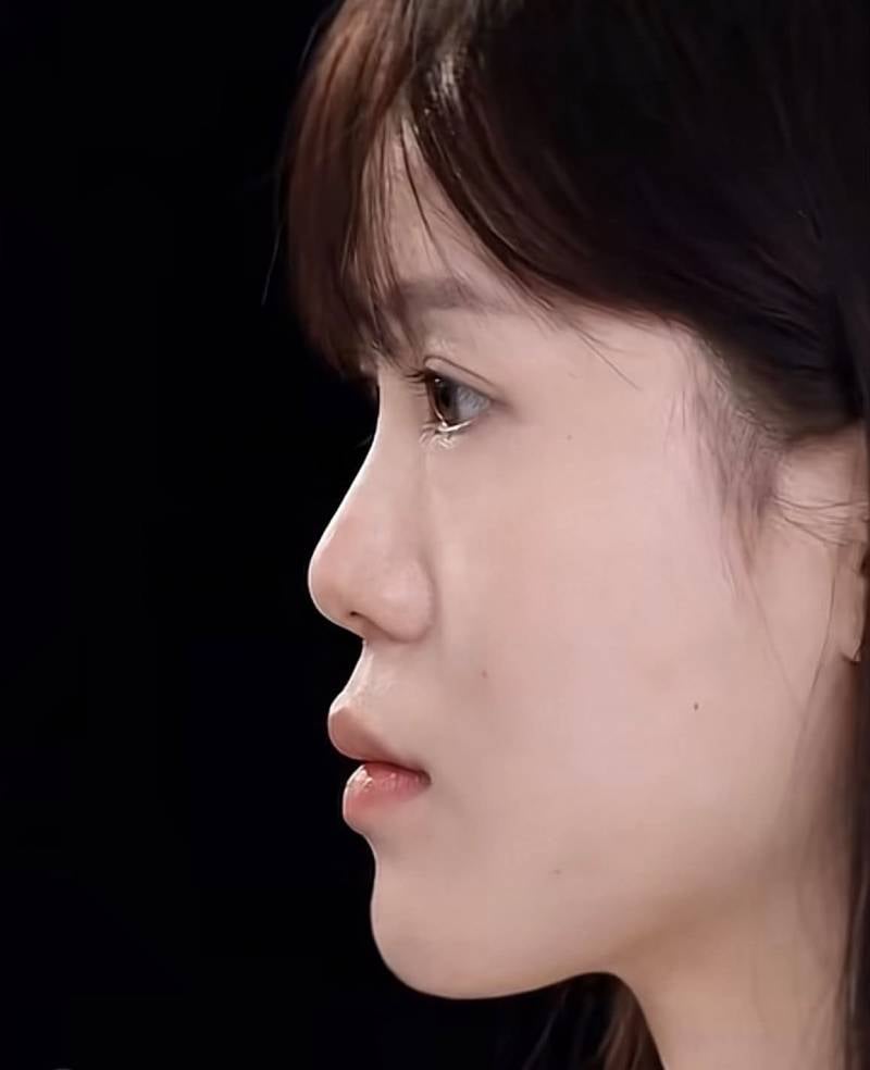 [잡담] 코수술 하면 진짜 이렇게 변해? | 인스티즈