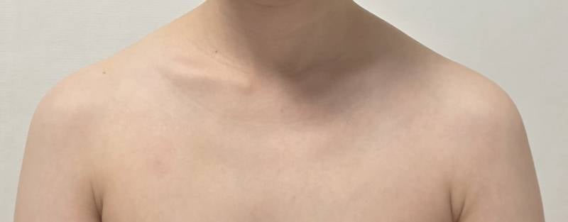[잡담] 승모근 보톡스 맞아볼까 | 인스티즈