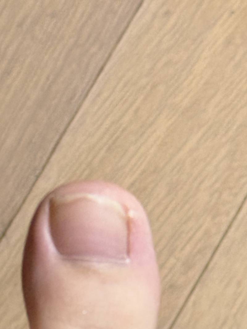 [잡담] 엄지 발톱 이런데 패디 가능하려나 ㅠㅜ⁉️(사진있음!!!!!!!) | 인스티즈
