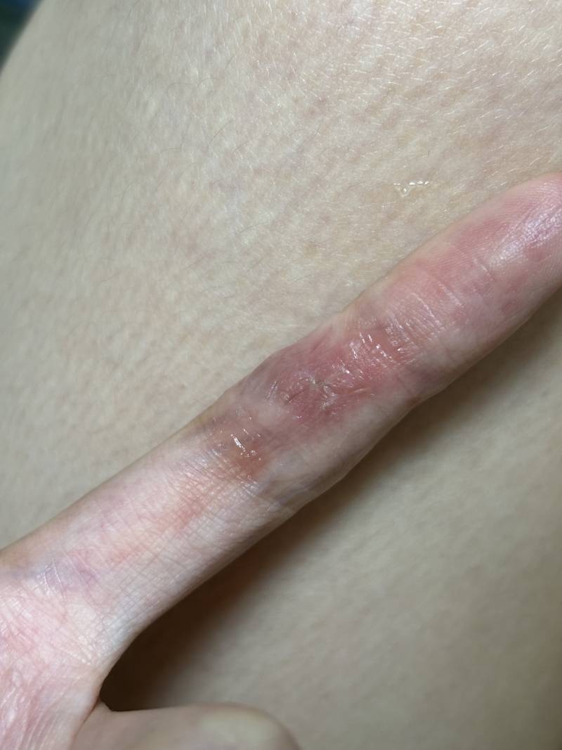[잡담] 실밥 품지 일주일됐는데 회복 되고 있는건가 ? | 인스티즈