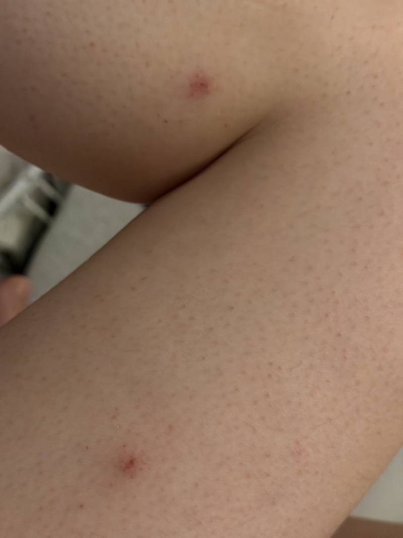 [잡담] 모기가 아닌 다른 벌레 물린건가? 🫪💦 | 인스티즈