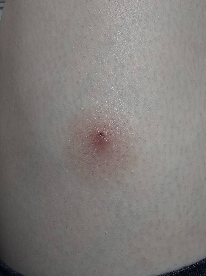 [잡담] 이거는 피부과가야하나 | 인스티즈