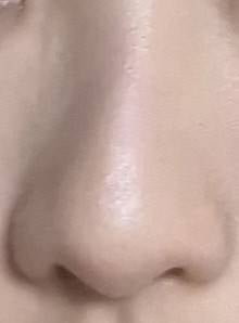 [잡담] 40 익들은 나같은 상황이라면 코수술 할 거 같아?? | 인스티즈