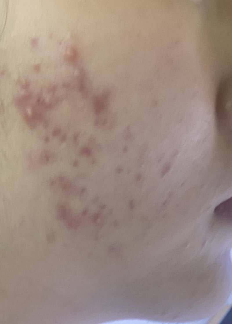 [잡담] 나도여드름진짜개개개심했는데 이젠좀꿀피부임 ㅎㅇㅈㅇ | 인스티즈