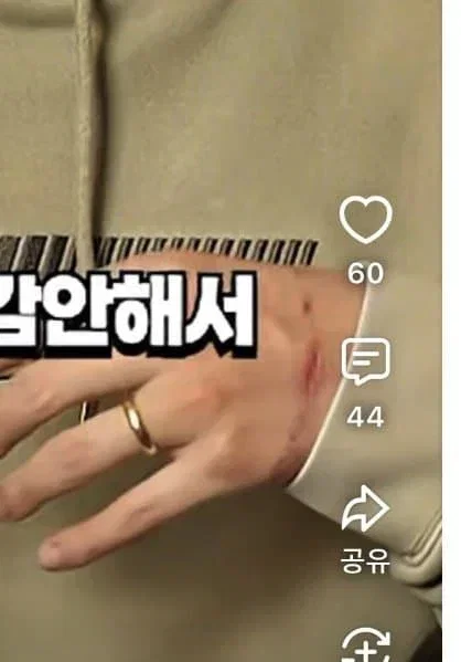 [잡담] 서출구 손 많이 다쳤네; | 인스티즈