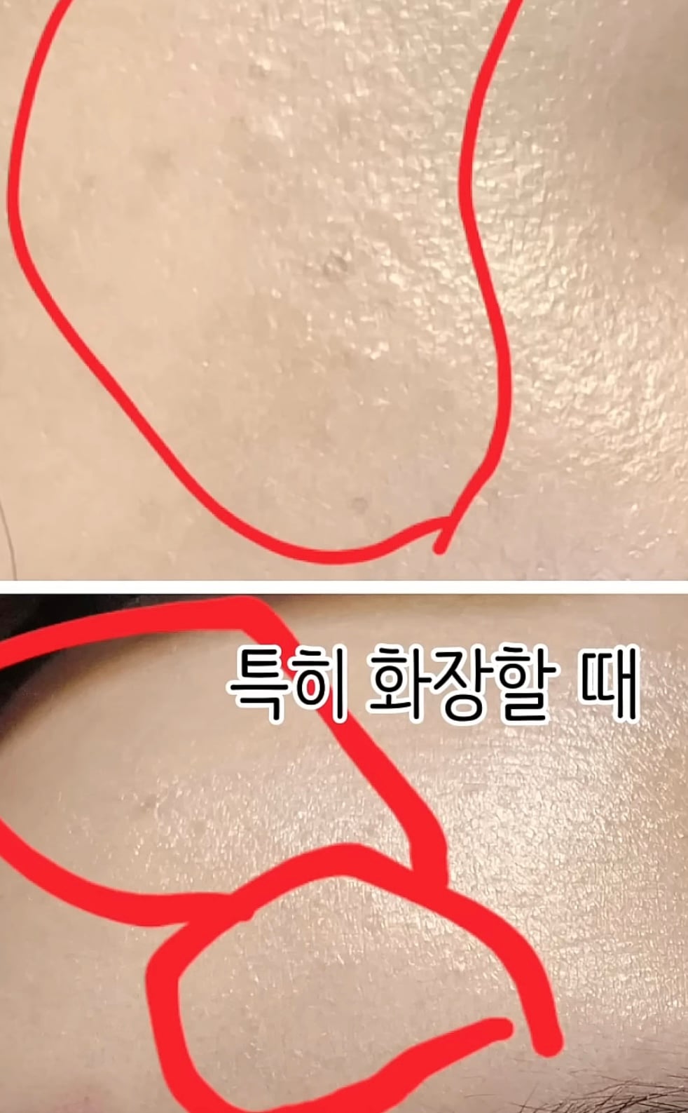 [잡담] 이런게 편평사마귀였다구…..? | 인스티즈