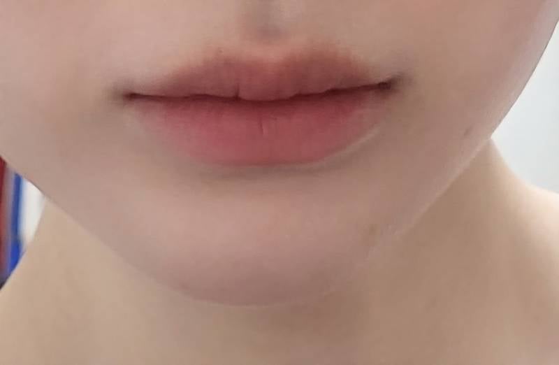 [잡담] 나 내일 입술필러녹이러가는데 | 인스티즈