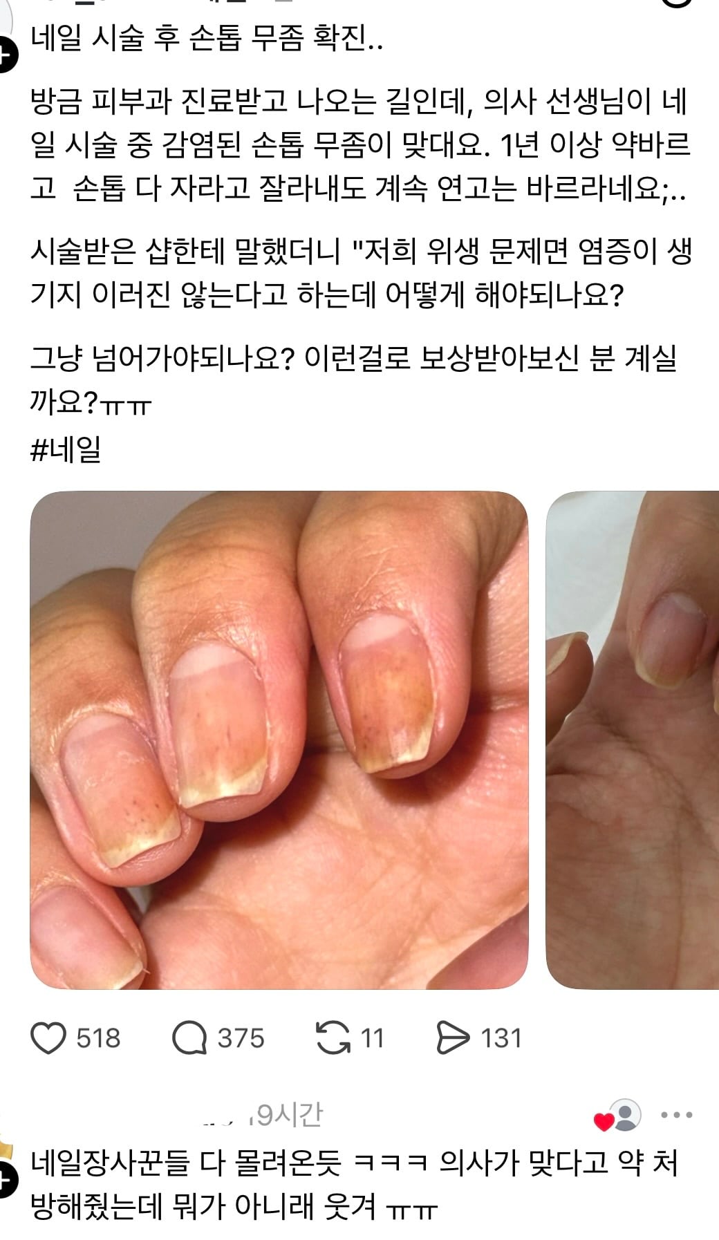 [잡담] 으악 이분 네일샵에서 손톱 무좀 전염됐대 네일 자주하는 익들아 위생 괜찮은 곳 가렴.. | 인스티즈