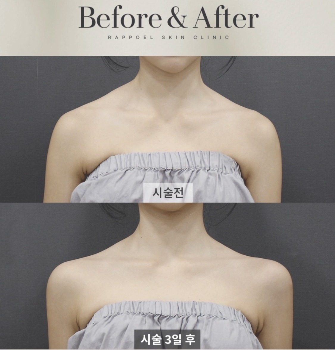 최근들어 직각어깨가 급 많아진 이유 (f.조두팔) | 인스티즈