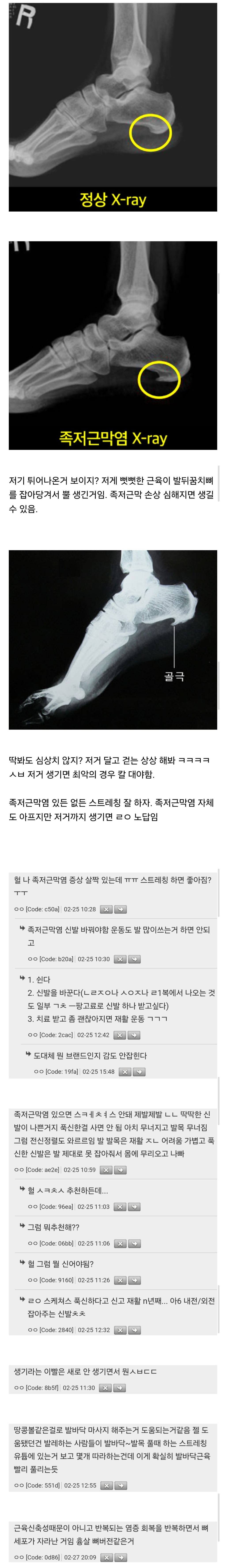 족저근막염 내버려두면 발바닥에 뿔도 생김 | 인스티즈