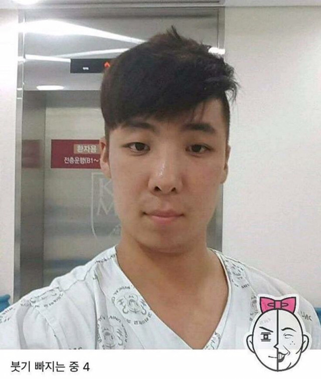 염색약 부작용 ㅎㄷㄷ(혐오주의) | 인스티즈