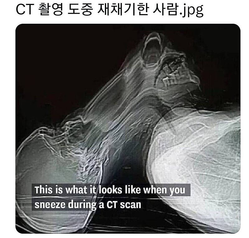 CT 촬영중 재채기하면 일케 됨 | 인스티즈