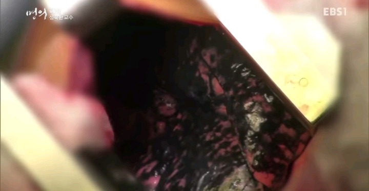 폐암 3기환자의 폐.jpg (사진주의) | 인스티즈