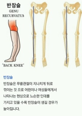 [반장슬] 다리모양 분명 이렇게 생긴 여시들 있을거야!(종아리가 뒤로 빠진 형태) | 인스티즈