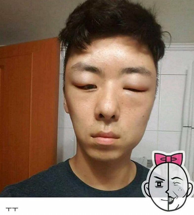 염색약 부작용 ㅎㄷㄷ(혐오주의) | 인스티즈