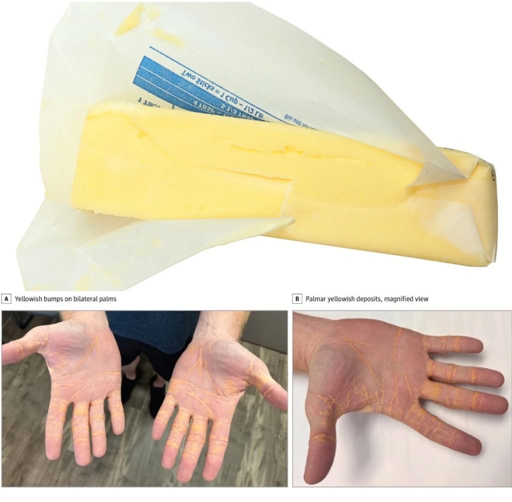 버터, 치즈, 소고기만 먹고 다이어트한 사람 결과 | 인스티즈