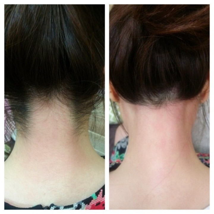 여자 뒷목 왁싱 전/후.jpg | 인스티즈