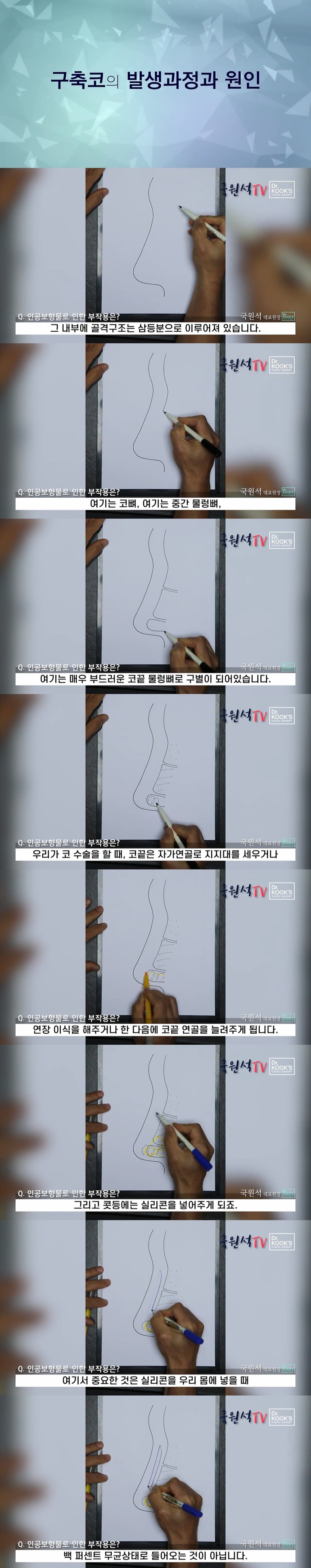 코 성형 후 구축이 생기는 과정 | 인스티즈